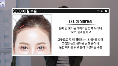 남편도 모르는 티안나는 극강의효과 동안성형 이마거상