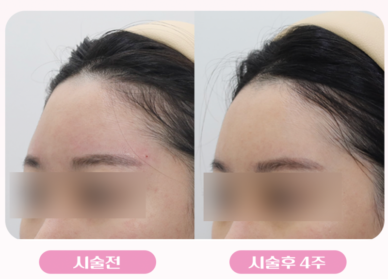 강남역 이마필러 추천! 아직도 앞머리로 이마 가리시나요? 볼륨있는 이마로 동안 만들기 사진 7