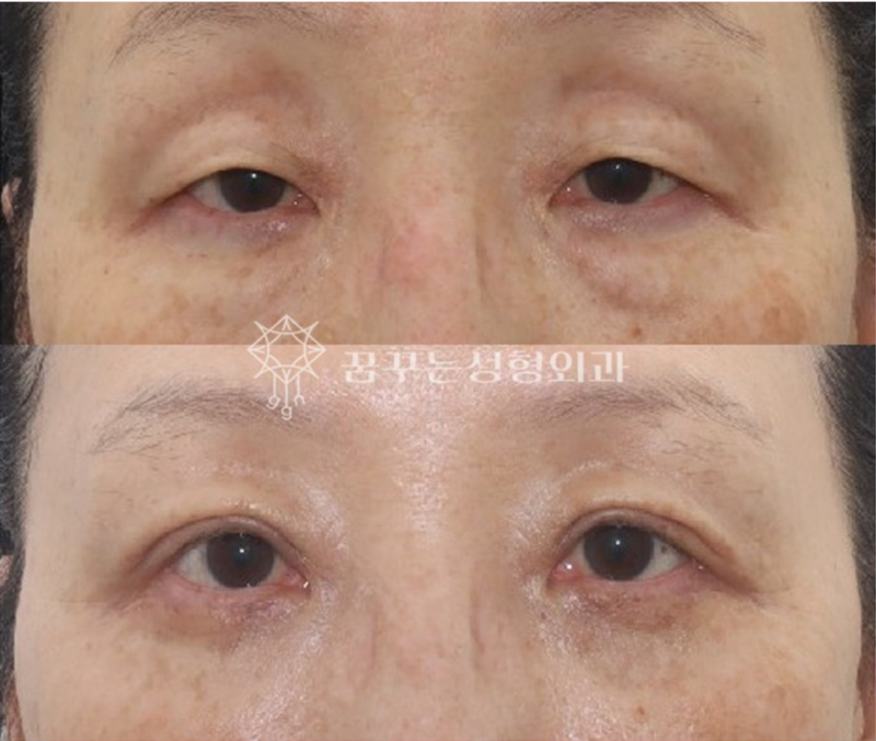 강남 상안검 잘하는 곳, 눈두덩이 쑥 꺼지고 퀭한 눈이 고민이라면 사진 4