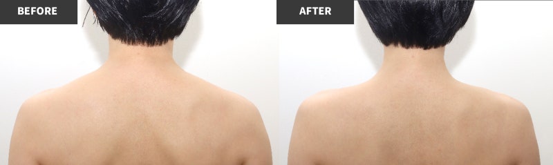 강남역 다이어트 지방흡입 이중턱, 승모근, 종아리보톡스 사진 9