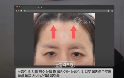 속시원한 중년쌍꺼풀의 진실, 이걸몰라서 제친구가 망했군요 사진 10