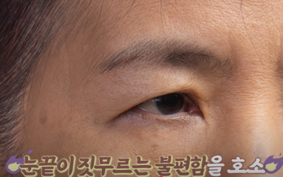 속시원한 중년쌍꺼풀의 진실, 이걸몰라서 제친구가 망했군요 사진 18