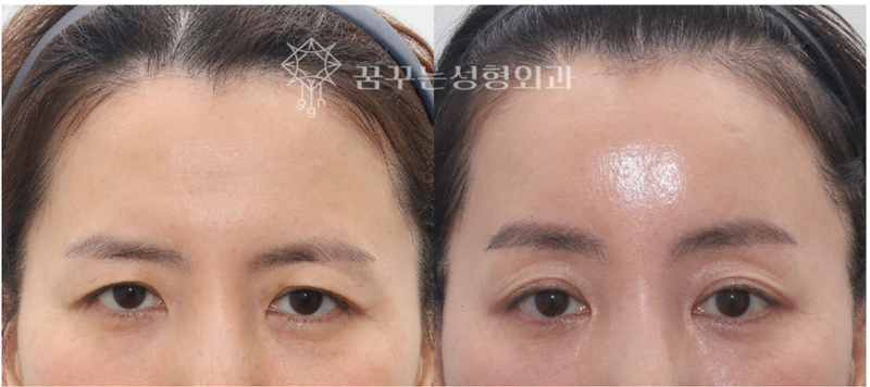 강남역 중년성형에도 트렌드가 있다. 사진 5