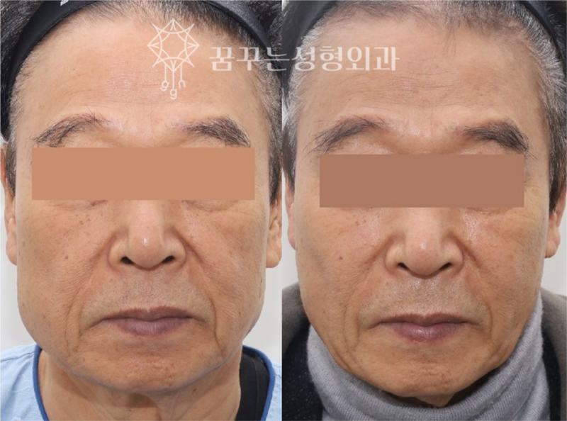 강남역 중년성형에도 트렌드가 있다. 사진 14
