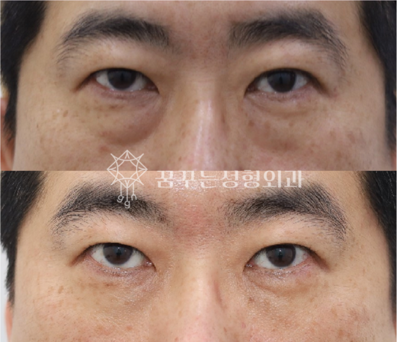 강남역 중년성형에도 트렌드가 있다. 사진 11