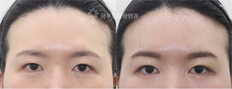 강남역 성형외과 의사가 ‘눈밑지방재배치 수술’을 권하지 않았던 이유 사진 3