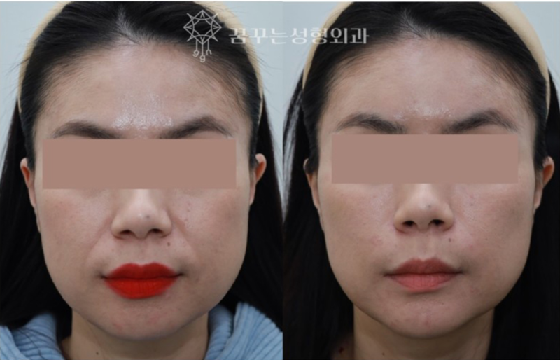 강남역 필러 후기, 아무데서나 하면 큰일 납니다. – 필러 전문 의학석사에게 받으세요! 사진 17