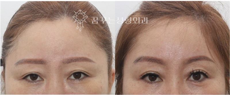 강남역 이마거상 잘하는 병원? 챗GPT에게 물어봤다 사진 11