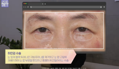 우리아빠 10살 어려보이는 중년남성 눈성형의 모든 것 사진 16