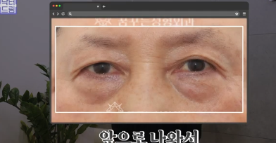 우리아빠 10살 어려보이는 중년남성 눈성형의 모든 것 사진 21
