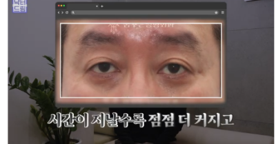 우리아빠 10살 어려보이는 중년남성 눈성형의 모든 것 사진 19