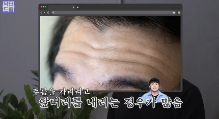 우리아빠 10살 어려보이는 중년남성 눈성형의 모든 것 사진 4