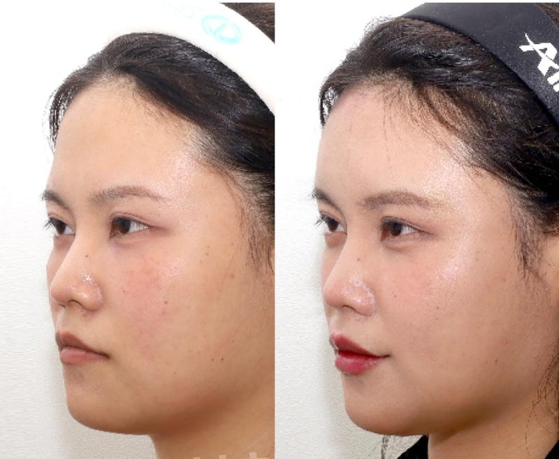 강남역 필러 잘하는 곳 시술 후기, 자연스럽게 올라간 입꼬리와 이마 볼륨으로 동안 만들기