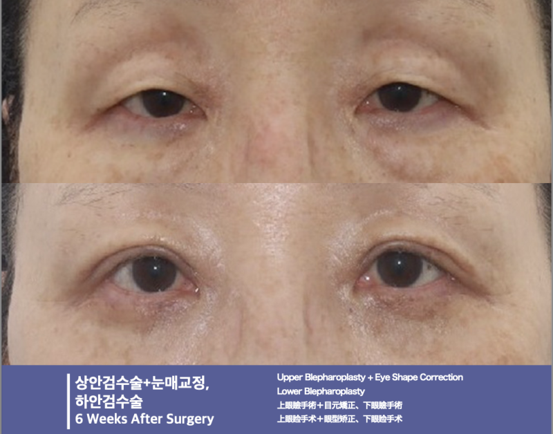 강남역 중년성형, 상안검·하안검 전문“20년은 젊어져요!” 눈성형 전문 성형외과 추천 사진 2