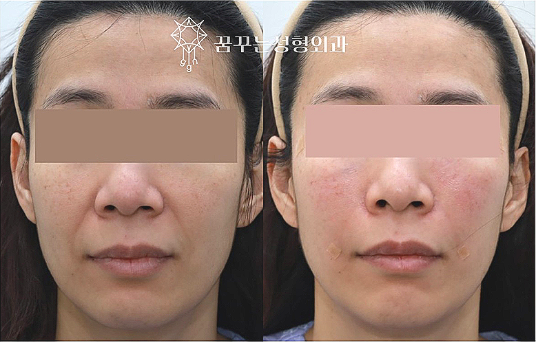 팔자주름 때문에 늙어보여요, 강남역 성형외과 전문의가 답한다 사진 15