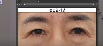 평생 딱 한번만 할 수 있는 수술 사진 18