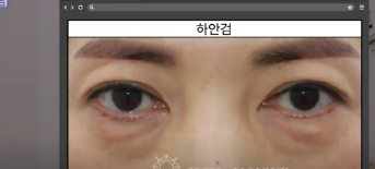 평생 딱 한번만 할 수 있는 수술 사진 16
