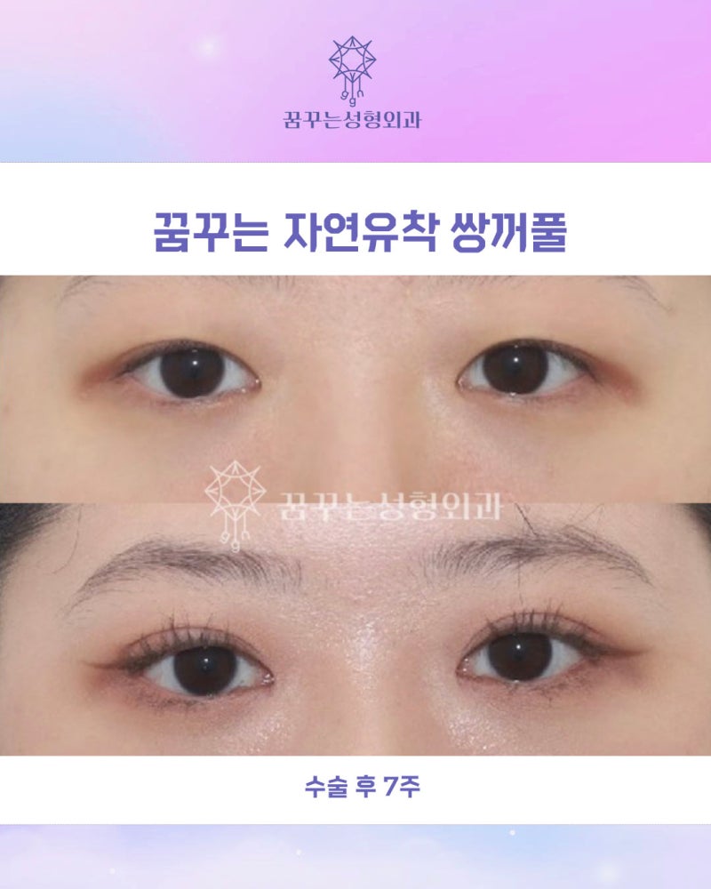 강남역 연예인 쌍꺼풀수술, 내 눈처럼 자연스러운 자연유착쌍꺼풀 사진 16