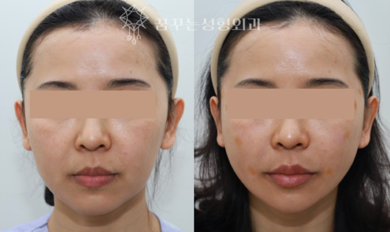 강남역 성형외과전문의, 늙어보이는 팔자주름 어떻게 해결할까? 사진 10