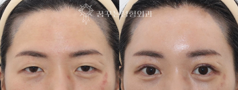 강남역 성형 전문의, 눈꺼풀 처짐 쌍꺼풀 수술로는 안된다고? 👀 해답은 내시경이마리프팅! 사진 8