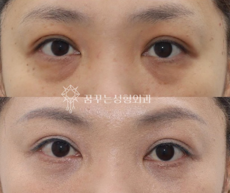 40대 눈밑지방재배치, 미루면 하안검 수술까지? 지금이 눈밑 안티에이징 골든타임입니다 | 강남역 꿈꾸는성형외과 사진 10