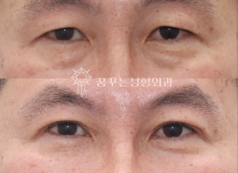 40대 눈밑지방재배치, 미루면 하안검 수술까지? 지금이 눈밑 안티에이징 골든타임입니다 | 강남역 꿈꾸는성형외과 사진 12