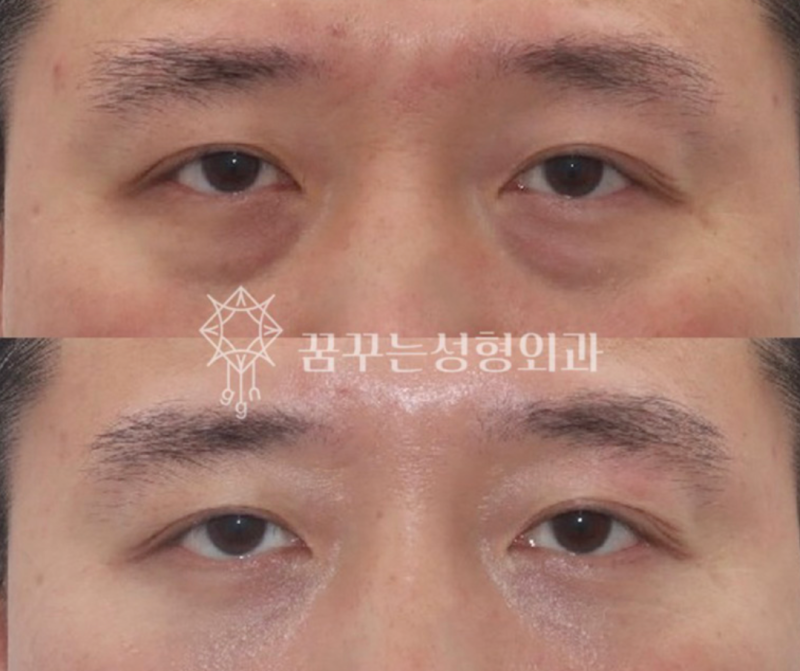 40대 눈밑지방재배치, 미루면 하안검 수술까지? 지금이 눈밑 안티에이징 골든타임입니다 | 강남역 꿈꾸는성형외과 사진 9