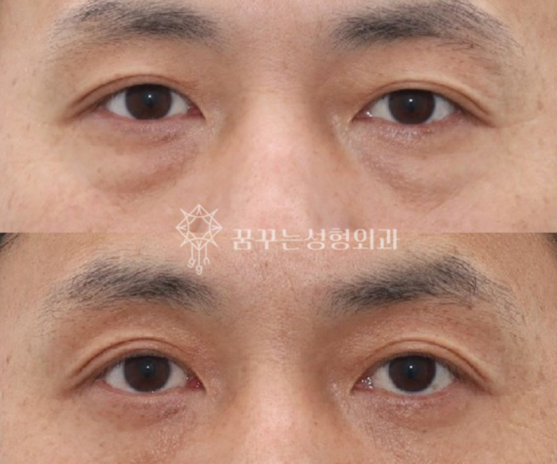 40대 눈밑지방재배치, 미루면 하안검 수술까지? 지금이 눈밑 안티에이징 골든타임입니다 | 강남역 꿈꾸는성형외과 사진 15