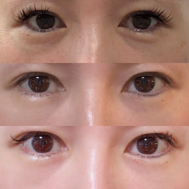 40대 눈밑지방재배치, 미루면 하안검 수술까지? 지금이 눈밑 안티에이징 골든타임입니다 | 강남역 꿈꾸는성형외과 사진 18