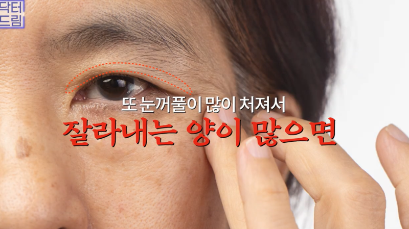 중년눈성형/눈처짐을 평정한 레전드 동안수술, 내시경이마거상 사진 6