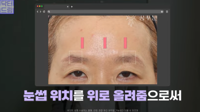 중년눈성형/눈처짐을 평정한 레전드 동안수술, 내시경이마거상 사진 12
