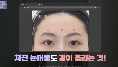 중년눈성형/눈처짐을 평정한 레전드 동안수술, 내시경이마거상 사진 10