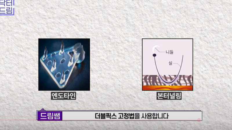 중년눈성형/눈처짐을 평정한 레전드 동안수술, 내시경이마거상 사진 18