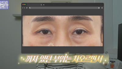 10살 늙어보이는 눈밑지방, 1시간만에 말끔히 해결됩니다 사진 22
