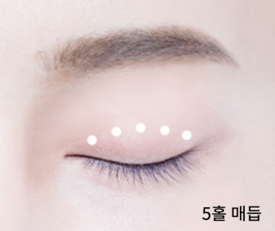 수능 끝! 강남역 자연유착 357펌라인으로 나에게 어울리는 쌍꺼풀 만들기, 대학생 새내기 첫 성형 사진 4