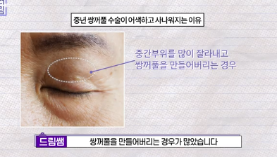 윗집 아줌마 쌍꺼풀 망했다며? 중년쌍꺼풀은 따로 있는데 아가씨들 하는걸 했대.. 사진 5