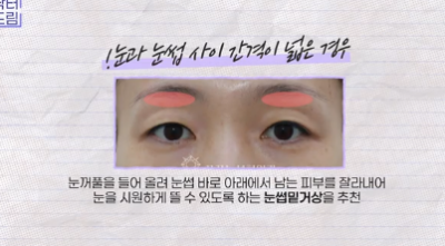 윗집 아줌마 쌍꺼풀 망했다며? 중년쌍꺼풀은 따로 있는데 아가씨들 하는걸 했대.. 사진 6