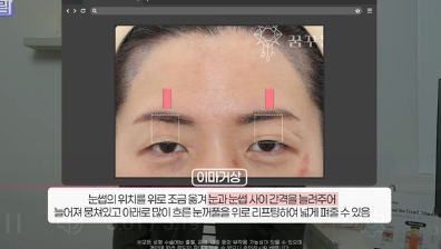 윗집 아줌마 쌍꺼풀 망했다며? 중년쌍꺼풀은 따로 있는데 아가씨들 하는걸 했대.. 사진 15