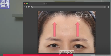 윗집 아줌마 쌍꺼풀 망했다며? 중년쌍꺼풀은 따로 있는데 아가씨들 하는걸 했대.. 사진 17