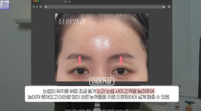윗집 아줌마 쌍꺼풀 망했다며? 중년쌍꺼풀은 따로 있는데 아가씨들 하는걸 했대.. 사진 18