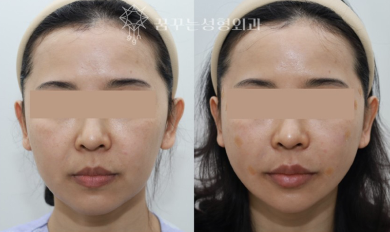 팔자주름 리프팅 비교 – 민트실 vs 필러 vs 리프팅 레이저강남역 안티에이징 전문 성형외과, 꿈꾸는 성형외과의 맞춤 해법