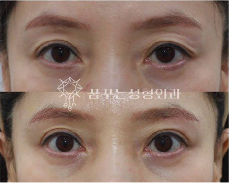 중년 눈처짐, 상안검 수술만이 답일까요? 자연스럽게 눈뜨임 개선하기 강남역 꿈꾸는성형외과 사진 6