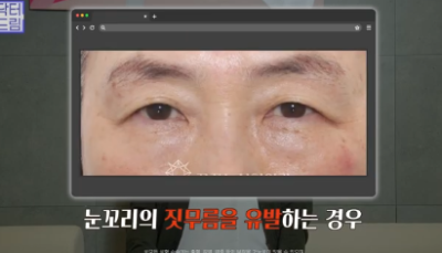 중년성형 필독! 망하는 병원 고르는 치명적 실수 3가지 사진 13