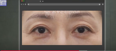 중년성형 필독! 망하는 병원 고르는 치명적 실수 3가지 사진 20