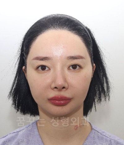 중안면 리프팅으로 동안 얼굴 만들기팔자주름·실리프팅으로 어려 보이는 인상 강남역 꿈꾸는 성형외과 사진 11