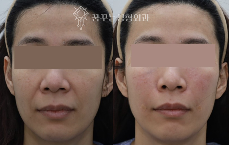 중안면 리프팅으로 동안 얼굴 만들기팔자주름·실리프팅으로 어려 보이는 인상 강남역 꿈꾸는 성형외과 사진 7