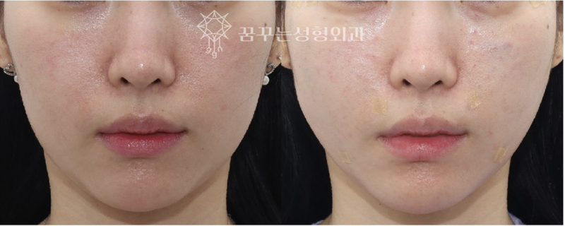 중안면 리프팅으로 동안 얼굴 만들기팔자주름·실리프팅으로 어려 보이는 인상 강남역 꿈꾸는 성형외과 사진 6