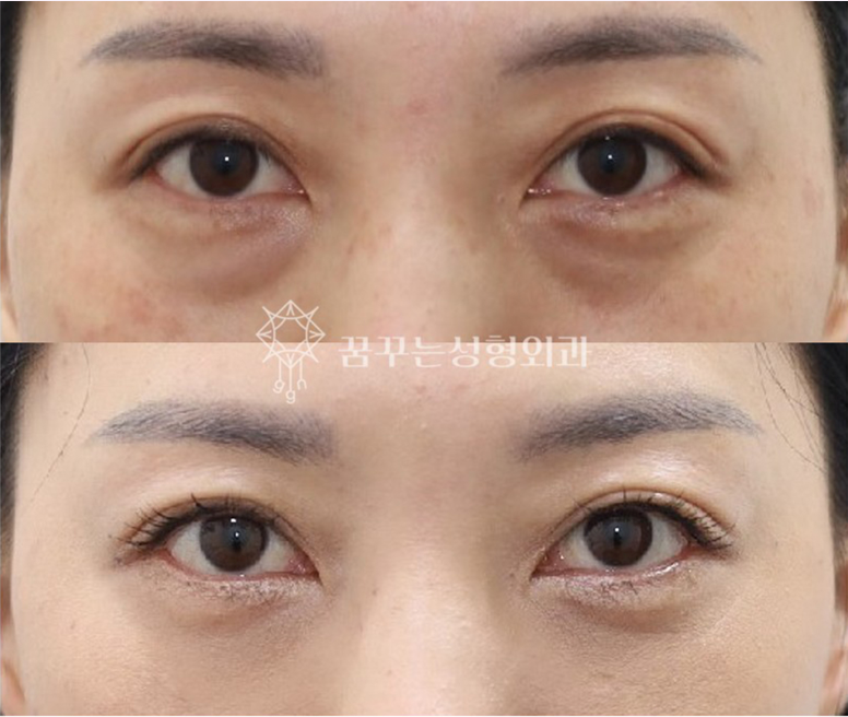 다크서클의 진짜 원인, 색소가 아니라 ‘구조’입니다. 눈밑지방재배치가 필요한 이유｜강남역 성형외과 눈밑 성형 가이드 사진 6