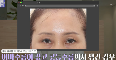 미인대회 출신 사부인 가볍게 밟아버린 중년동안수술 사진 21