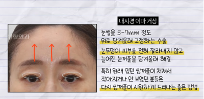 미인대회 출신 사부인 가볍게 밟아버린 중년동안수술 사진 16